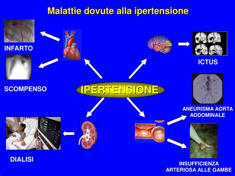 Ppt La Pressione Arteriosa Definizione Come Si Misura Lipertensione