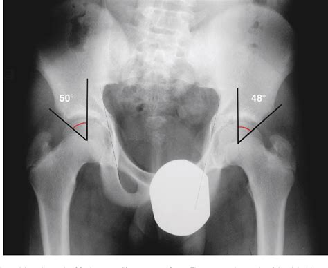 Figure From New Finding Of Protrusio Acetabuli In Two Families With