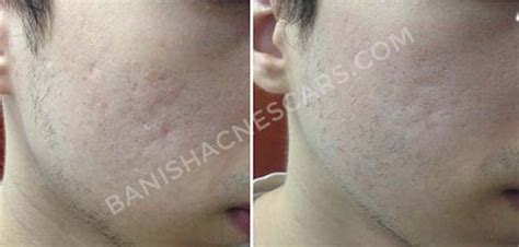 Banish Starter Kit - best facial kit for acne scars