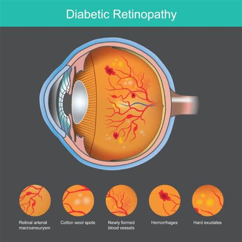 Diabetic Retinopathy Screening Eyecare Associates