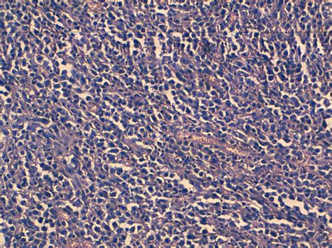 HES X 20 Diffuse Malignant Proliferation Mimicking Lobular Carcinoma