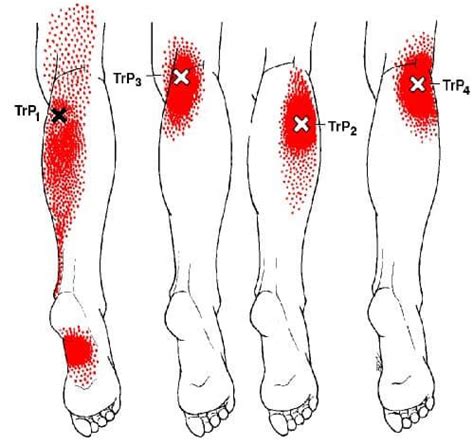 Trigger Points And Plantar Fasciitis Body Heal Therapy