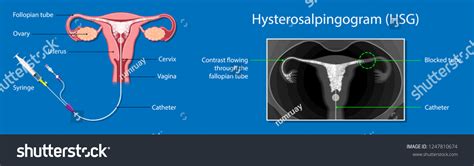 Hysterosalpingogram Hsg Test Blocked Fallopian Tubes Vector Có Sẵn