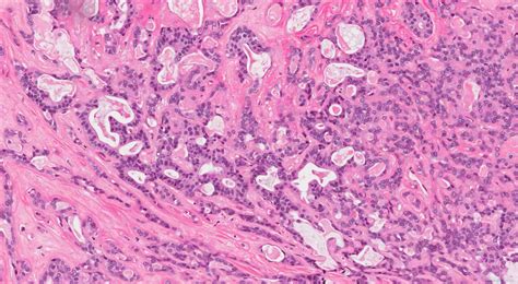 Polymorphous Adenocarcinoma Ottawa Atlas Of Pathology