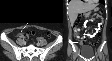 Dilated Appendix Is There More To It Case Report And Brief Review Of