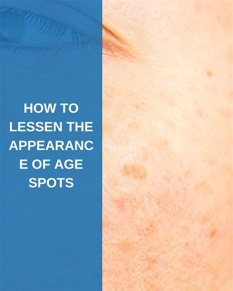 How To Lessen The Appearance Of Dark Spots Savannah River Dermatology