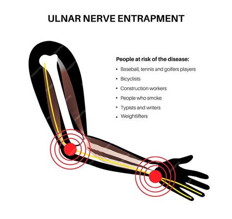 Premium Vector | Ulnar nerve entrapment