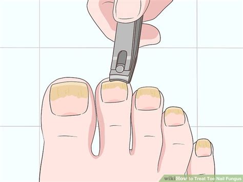 how to treat toe nail fungus at home
