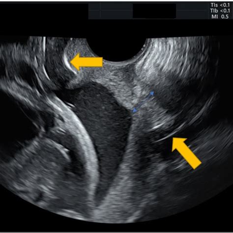 Trans Vaginal Ultrasound Image Measurement Of Cervical Length Blue