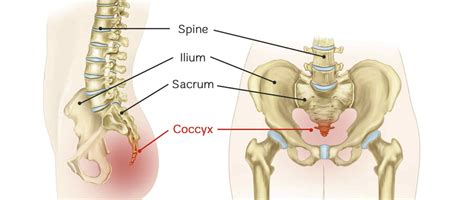 Relief for Coccyx (Tailbone) Pain: Dr Linda Schiller's Experience