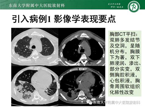 【ppt】金黄色葡萄球菌肺炎 影像ppt