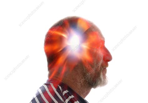 Exploding Head Syndrome Composite Conceptual Image Stock Image