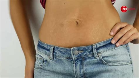 Stretch Marks Home Remedies These Home Remedies Will Reduce Your