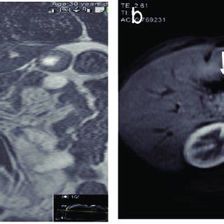 MRI Coronal T2 Weighted Image A And Axial Post Contrast Vibe Image