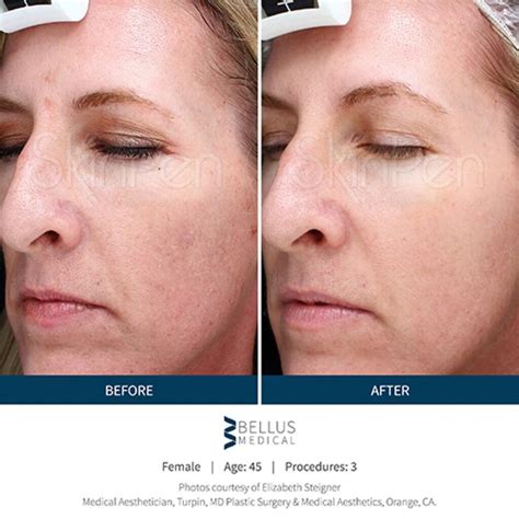 Skinpen Microneedling U S Dermatology Partners