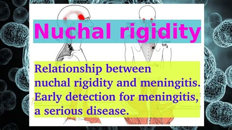 Nuchal Rigidity Meningitis