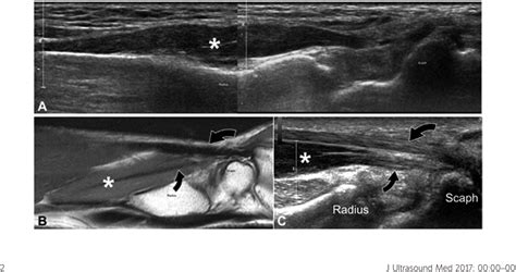 PDF Painful Flexor Carpi Radialis Brevis Muscle An Ultrasound And