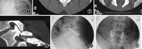 Lateral X Ray Shows L5 Spondylolysis And Almost Fused Disc Space Download Scientific Diagram