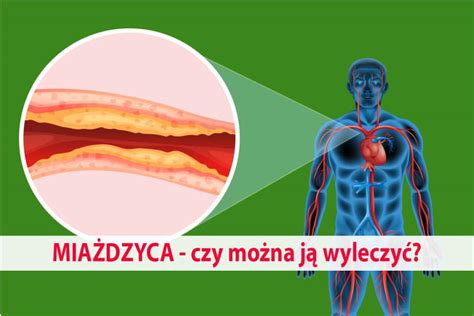 Miażdzyca najnowsze metody leczenia objawy profilaktyka diagnostyka