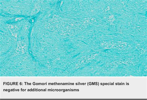 The special stain for acid-fast bacilli is negative | Download ...