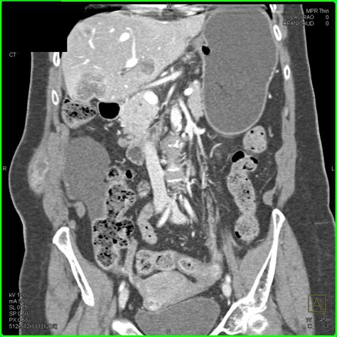 Metastatic Carcinoid Tumor With Vascular Metastases Liver Case