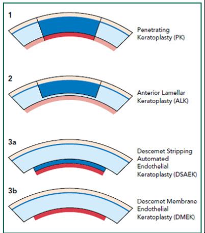 TYPES OF CORNEAL TRANSPLANTS (KERATOPLASTY) - Jehan Eye Clinic