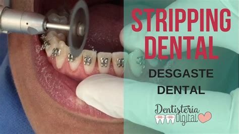 STRIPPING EN ORTODONCIA Interproximal Reduction YouTube