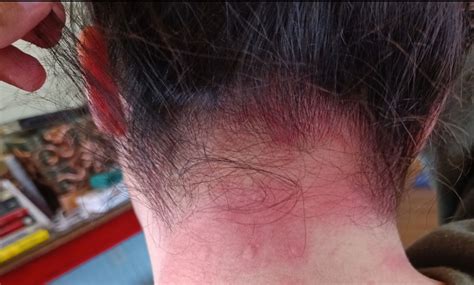 Stress Rash On Neck