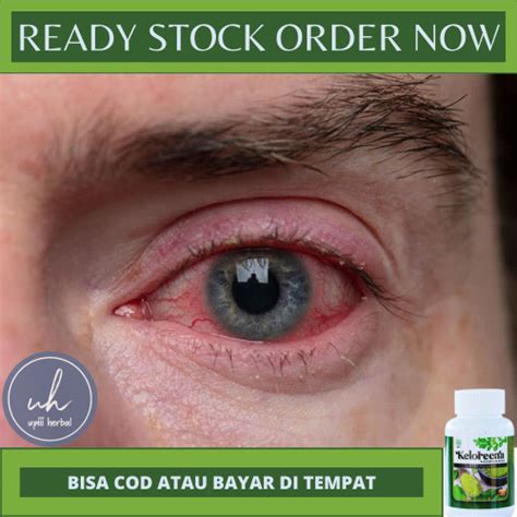 Jual Obat Radang Kelopak Mataobat Blefaritisobat Kesehatan Mataobat