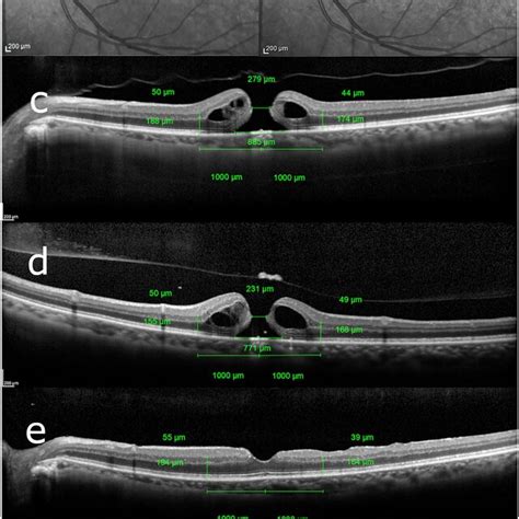 Measurement Of Optical Coherence Tomography Parameters In Macular Hole