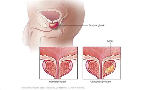 Penyebab Gejala Dan Risiko Kanker Prostat Yang Dialami Sby