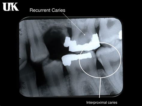 Ppt Radiology Of Caries Powerpoint Presentation Free Download Id