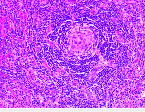 Histopathology Of The Right Sided Inguinal Lymph Node Showing Marked Download Scientific