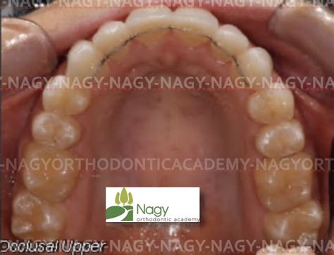 Unwanted Tooth Movement With Fixed Lingual Retainers Nagy Orthodontic