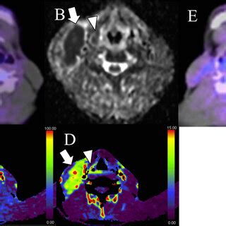 A 63-year-old man with right oropharyngeal squamous cell carcinoma ...