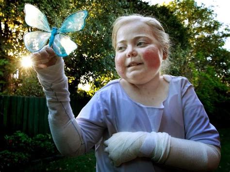 Epidermolysis Bullosa Disease Is ‘worst Youve Never Heard Of The