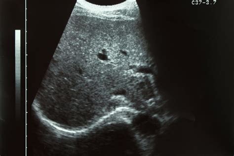 Liver Cysts Develop During MTC Treatment With Vandetanib