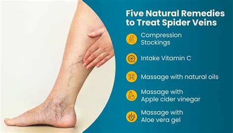 Understanding Spider Veins Causes Remedies And Treatment