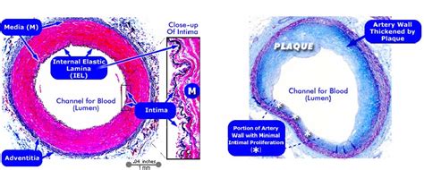 Figure 1 From Shape Driven Segmentation Of The Arterial Wall In Intravascular Ultrasound Images