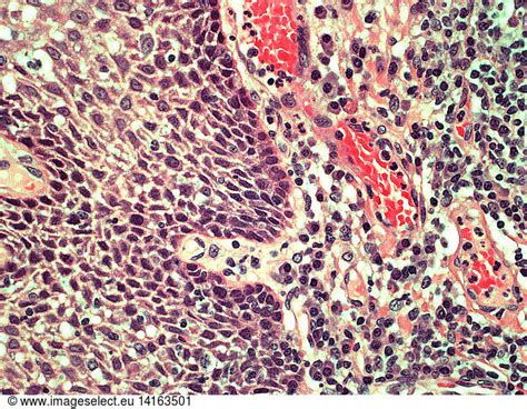 Reactive Lymph Node Reactive Lymph Node, Germinal Centers (LM),abnormal,abnormality,imaging ...