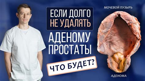 Осложнения и последствия аденомы простаты - YouTube
