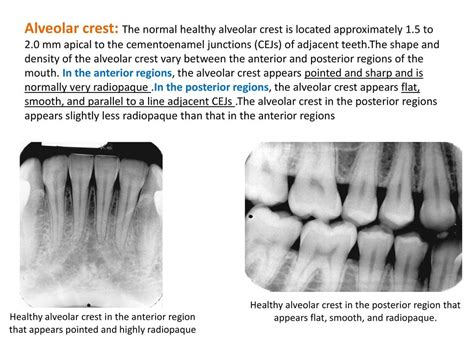 Alveolar Crest Radiograph