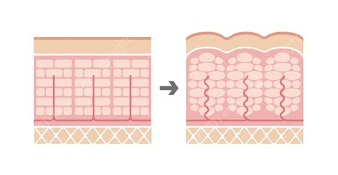 Illustration Comparing Typical Skin And Skin Affected By Cellulite