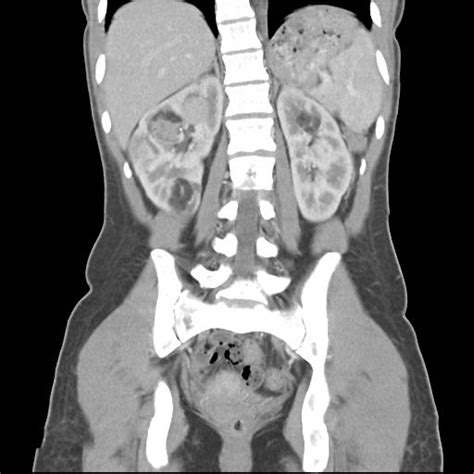 Tuberous Sclerosis Multisystem Involvement Image