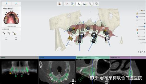 成都布莱梅联合口腔医院种已步入数字化口腔种植40时代！“真种植”是真的值！ 知乎