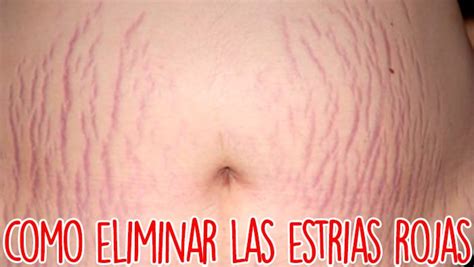 Como Eliminar Las Estrías Rojas