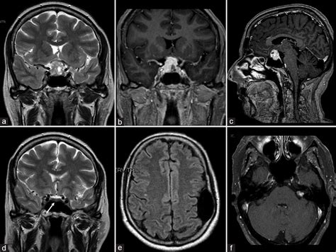 Surgical Neurology International