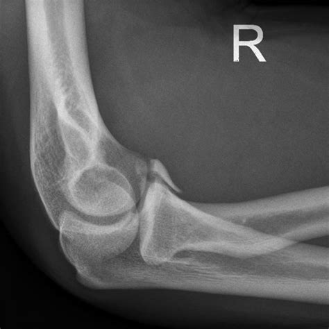 Coronoid Process Fractures Radiography Process Fractures