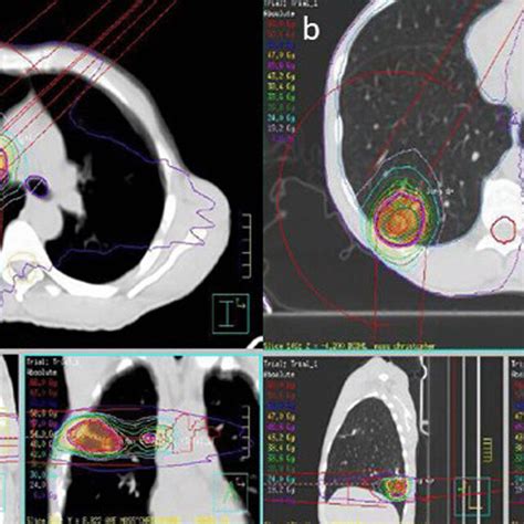 Computed Tomography Planning Scan And Isodose Lines Representing