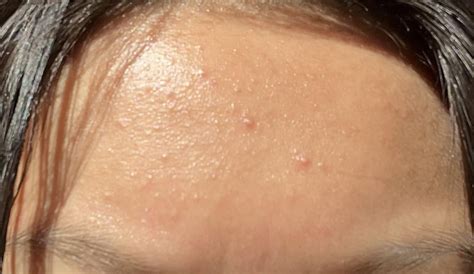 [routine Help] Small Bumps On Forehead R Skincareaddiction